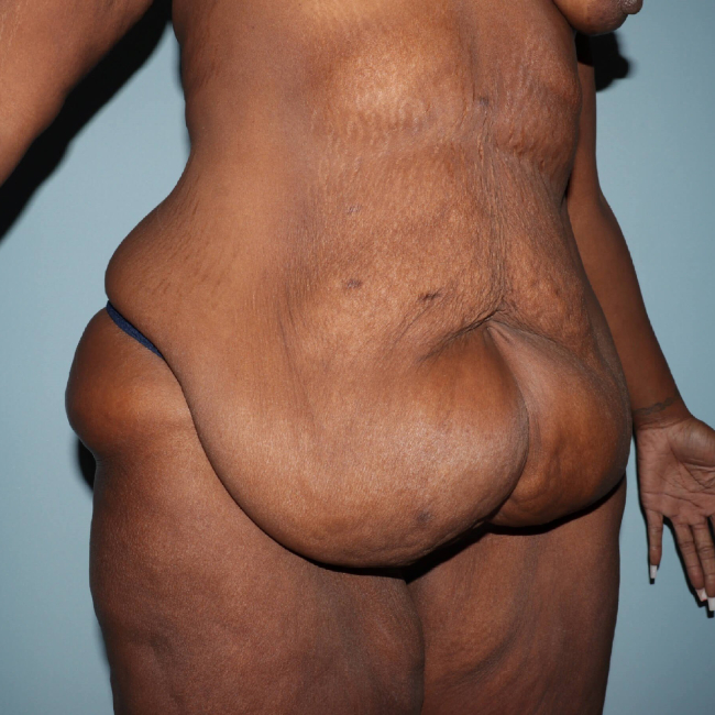 Before Image of Lower Body Lift Circumferential Abdominoplasty After Bariatric Surgery Right Side 45 degree View P-7632