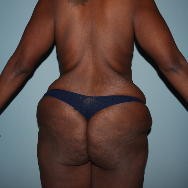 Before Image of Lower Body Lift Circumferential Abdominoplasty After Bariatric Surgery Back Side View P-7632