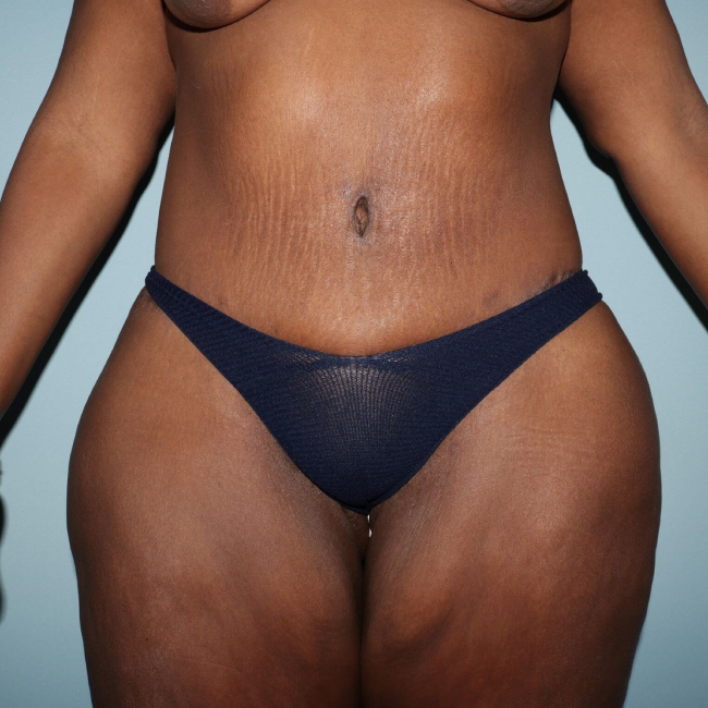After Image of Lower Body Lift Circumferential Abdominoplasty After Bariatric Surgery Front Side View P-7632