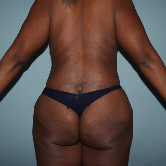 After Image of Lower Body Lift Circumferential Abdominoplasty After Bariatric Surgery Back Side View P-7632