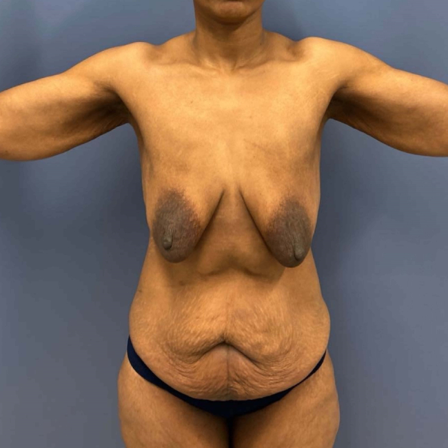 Before Image of Lower Body Lift and Brachioplasty Combo female patient front view P-7631