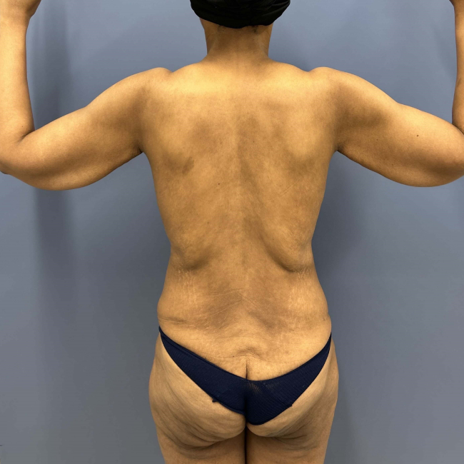Before Image of Lower Body Lift and Brachioplasty Combo female patient Back view P-7631