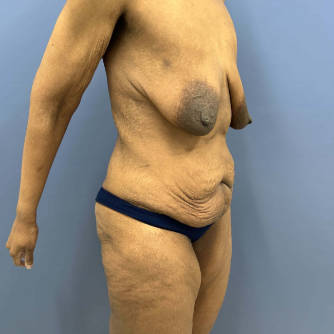 Before Image of Lower Body Lift and Brachioplasty Combo female patient Right Side 45 degree view P-7631