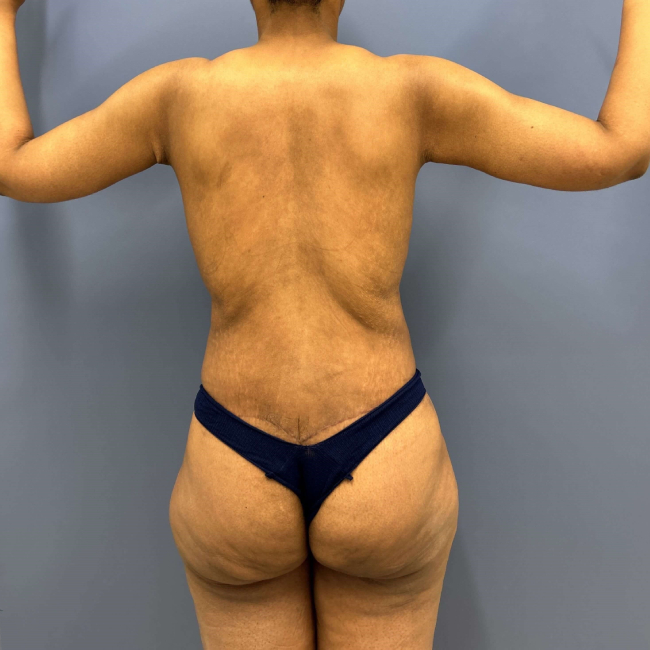 After Image of Lower Body Lift and Brachioplasty Combo female patient Back view P-7631