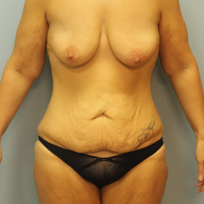 before lower body lift female patient front view case 7630
