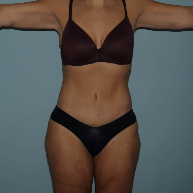 after lower body lift female patient front view arms up case 7630