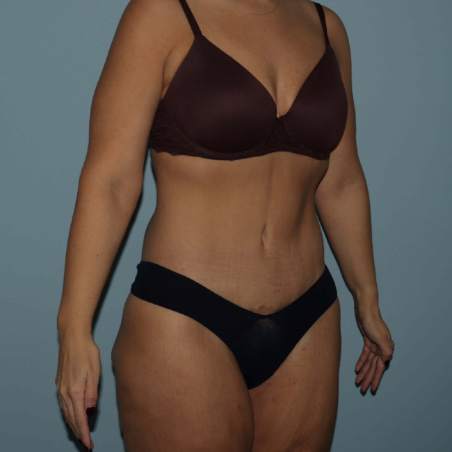 after lower body lift female patient right angle arms up case 7630