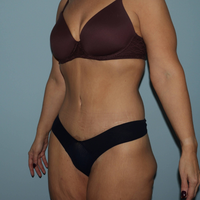 after lower body lift female patient left angle case 7630