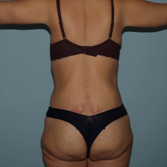 after lower body lift female patient back view case 7630