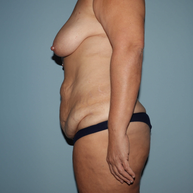 before lower body lift female patient left side view case 7616