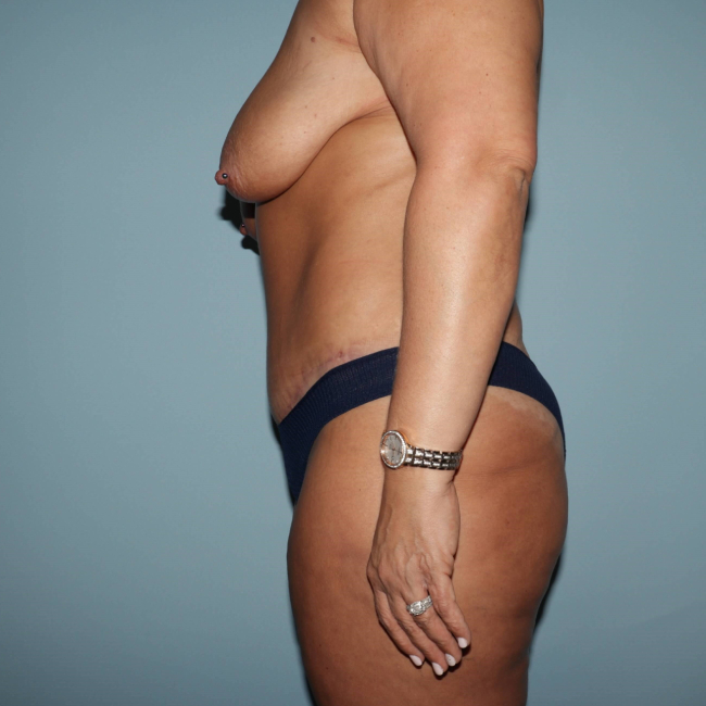 after lower body lift female patient left side view case 7616