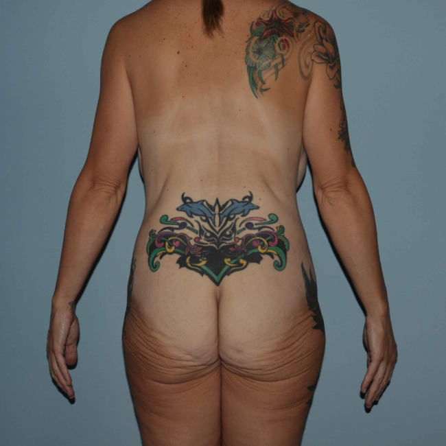 before lower body lift female patient back view case 7599