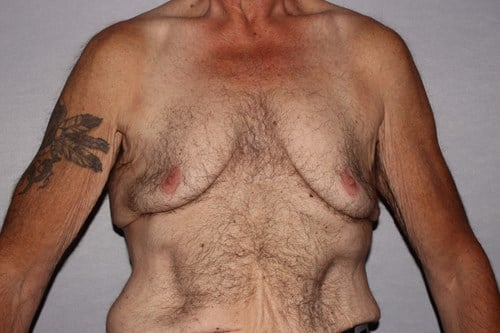 before lower body lift male patient back view case 7584