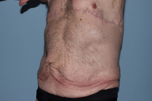 before lower body lift male patient left angle view case 7584