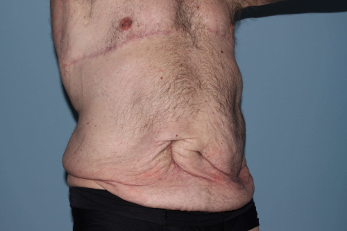 before lower body lift male patient right angle view case 7584