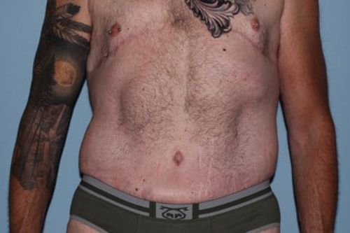 after lower body lift male patient back view case 7584