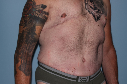 after lower body lift male patient right angle view case 7584