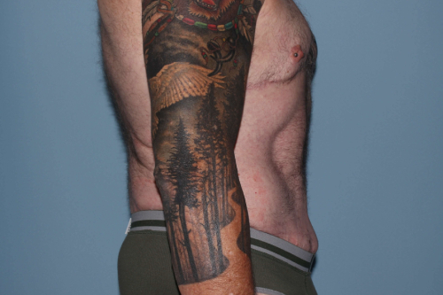 after lower body lift male patient right side view case 7584