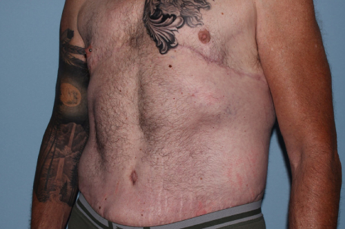 after lower body lift male patient left angle view case 7584