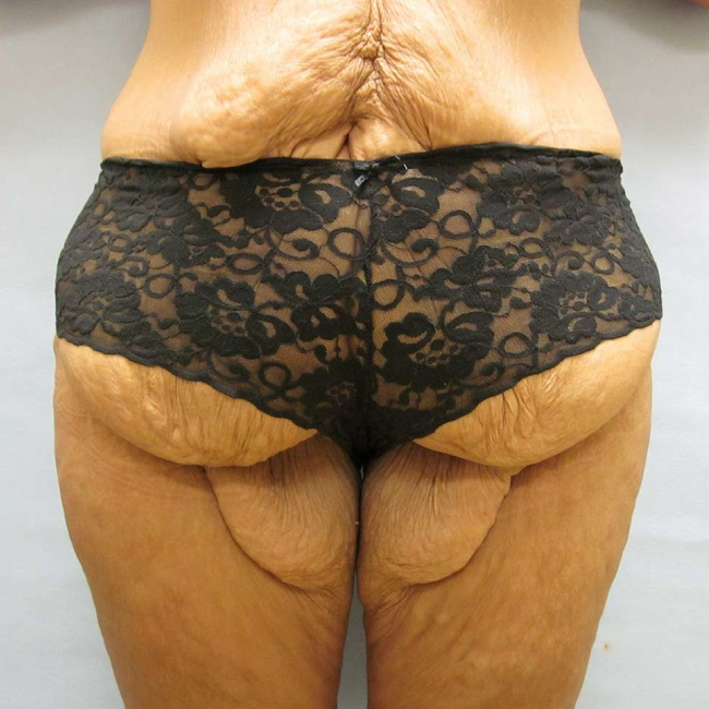 before lower body lift female patient front view case 7562