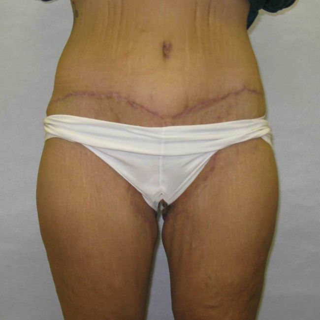 after lower body lift female patient front view case 7562