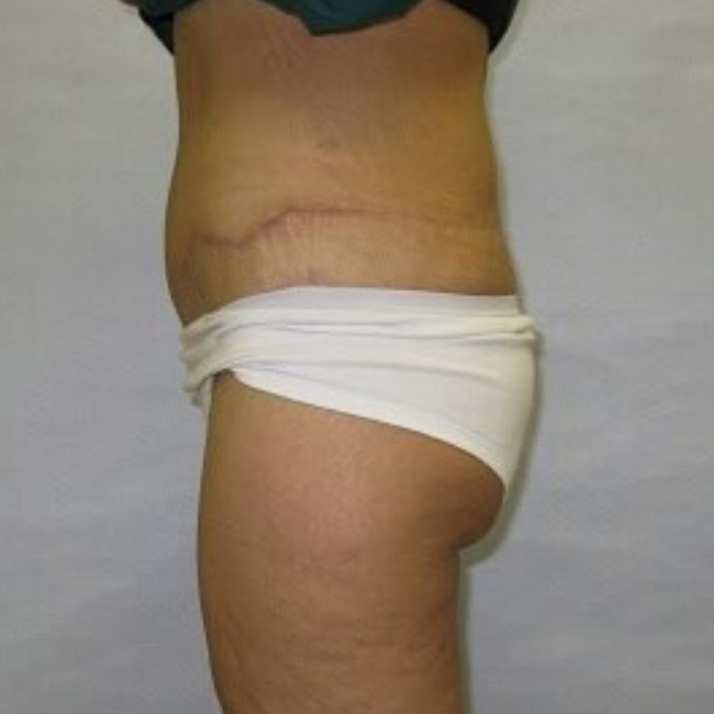 after lower body lift female patient Left side view case 7562