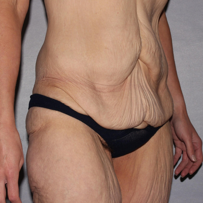 before lower body lift female patient right angle view case 7543