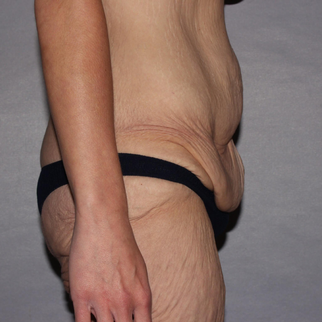 before lower body lift female patient right side view case 7543