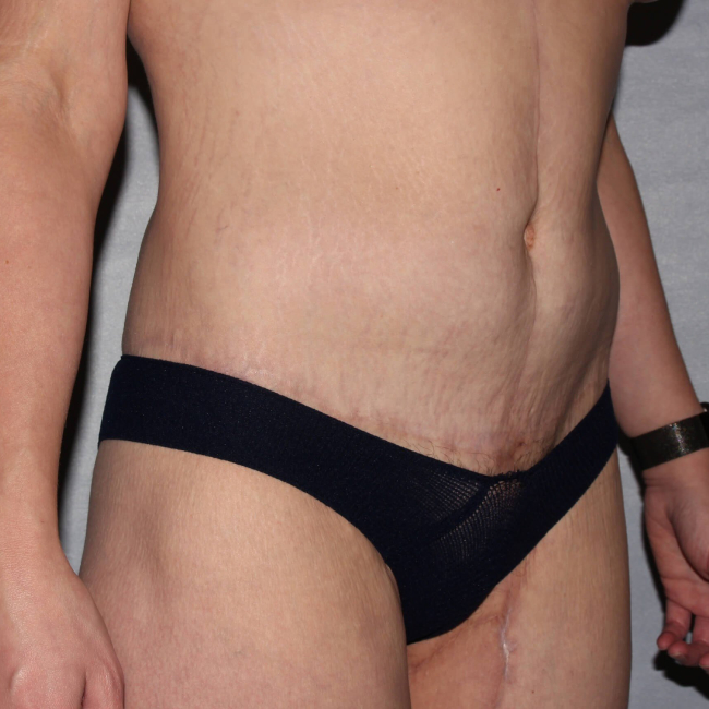 after lower body lift female patient right angle view case 7543