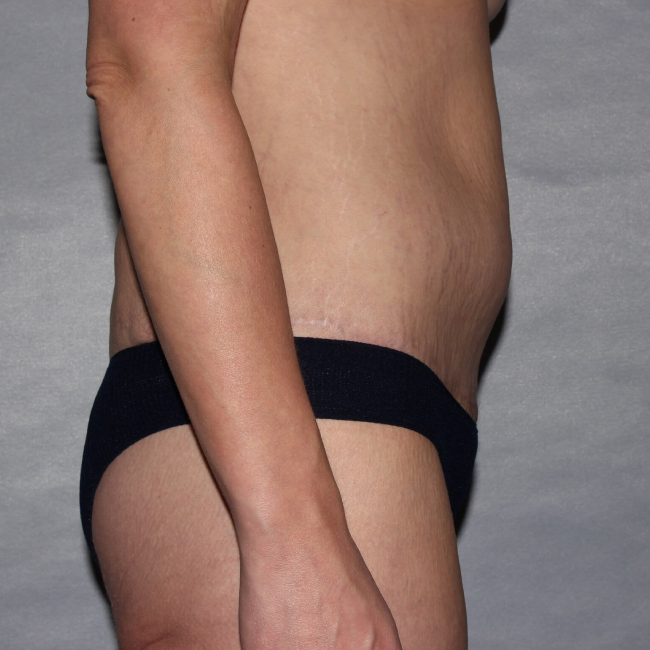 after lower body lift female patient right side view case 7543