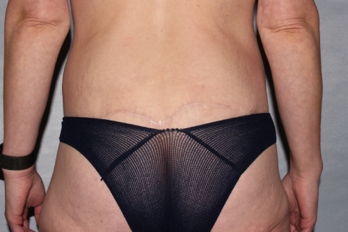 after lower body lift female patient back view case 7543