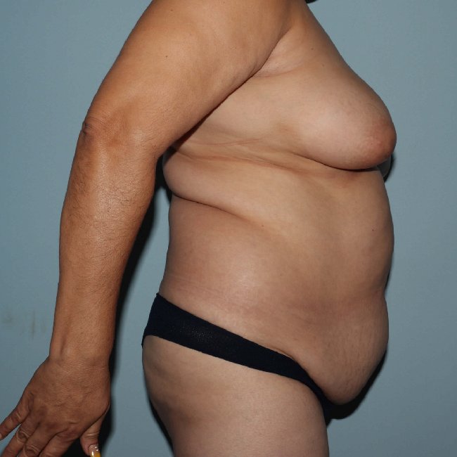 image before mommy makeover of a former smoker - right angle case 6321