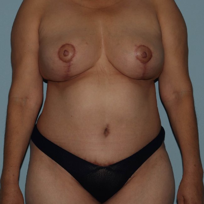 image after mommy makeover of a former smoker - front view case 6321