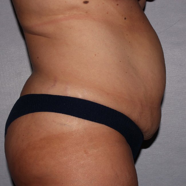 image before mommy makeover - 47yr old patient right angle stomach view case 6334