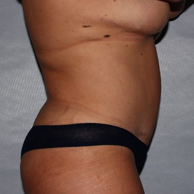 image after mommy makeover - 47yr old patient right angle stomach view case 6334
