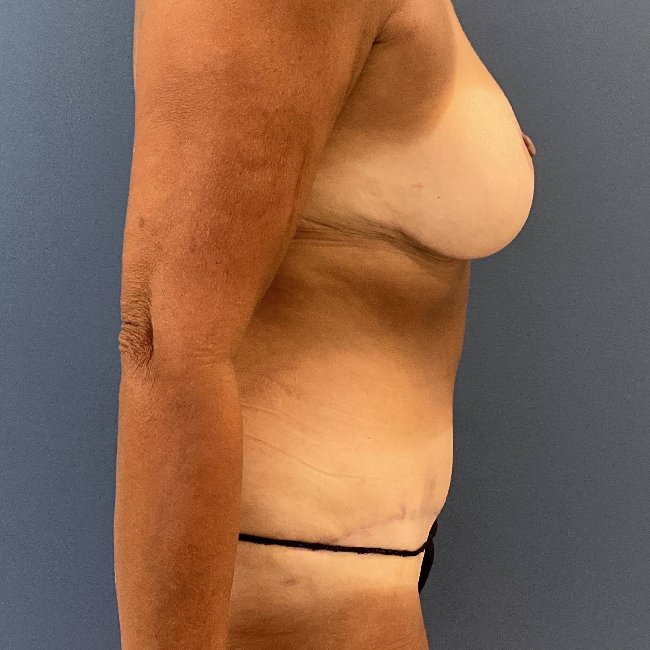 After Image of Mommy Makeover for 55 year old Right Side View P-6343