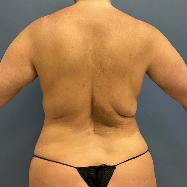 Before Image of Mommy Makeover for 49-year-old Back Side View P-6352