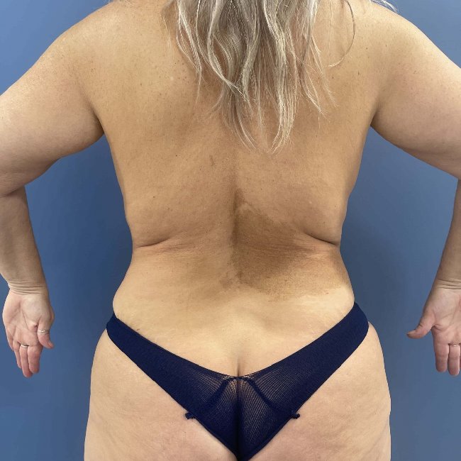 After Image of Mommy Makeover for 49-year-old Back Side View P-6352
