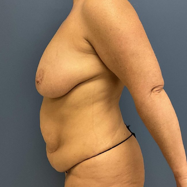 Before Image of Mommy Makeover for 49-year-old Left Side View P-6352