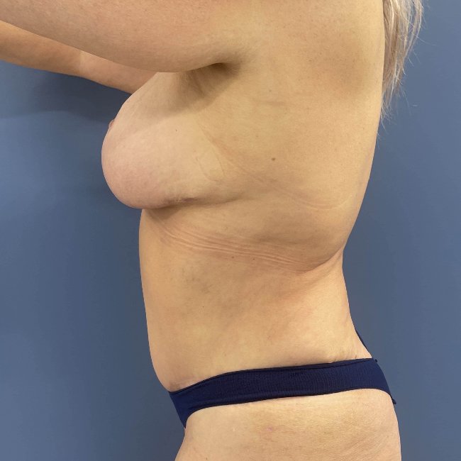 After Image of Mommy Makeover for 49-year-old Left Side View P-6352