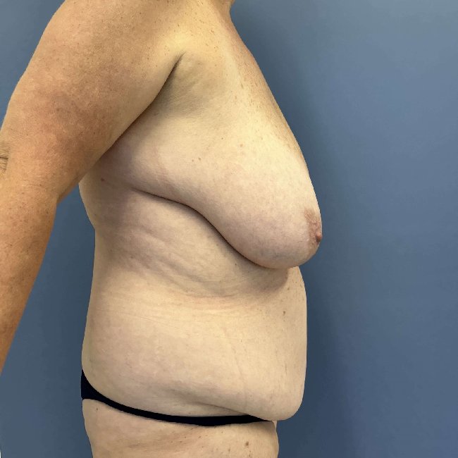 Before Image of Overweight Mommy Makeover Right Side View P-6364