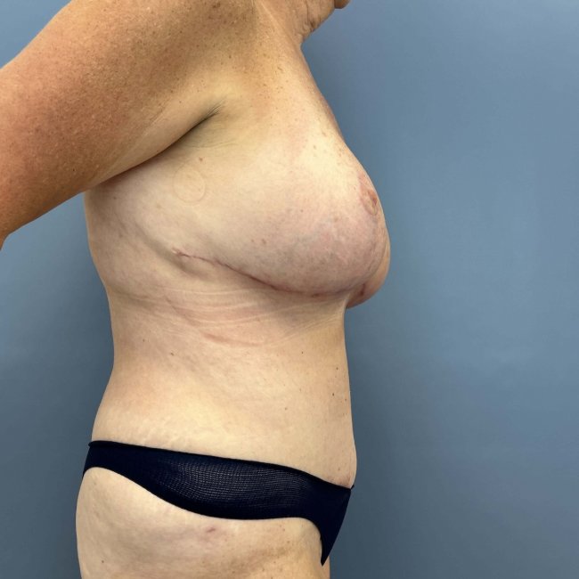 After Image of Overweight Mommy Makeover Right Side View P-6364