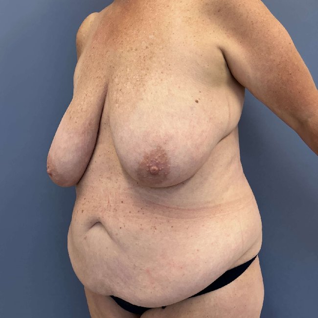 Before Image of Overweight Mommy Makeover Left Side 45 degree View P-6364