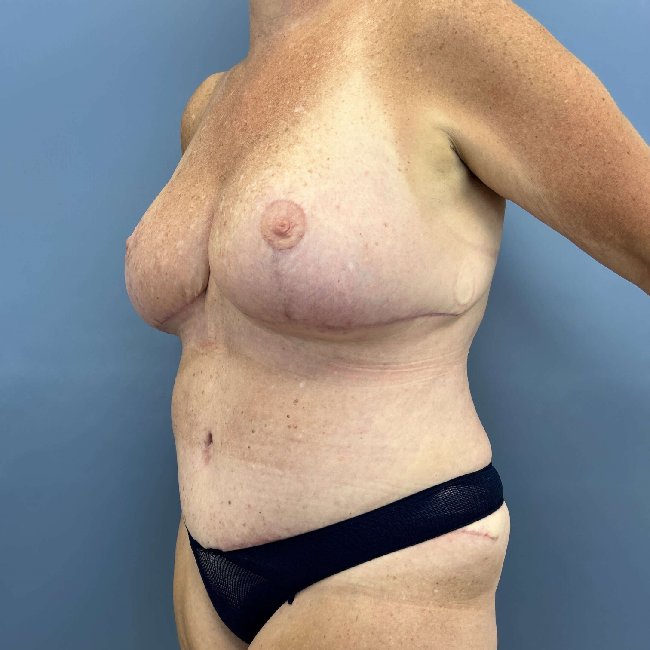 After Image of Overweight Mommy Makeover Left Side 45 degree View P-6364