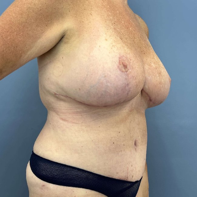 After Image of Overweight Mommy Makeover Right Side 45 degree View P-6364