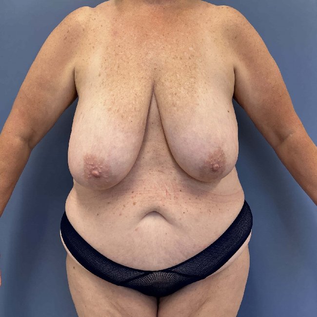 Before Image of Overweight Mommy Makeover Front Side View P-6364