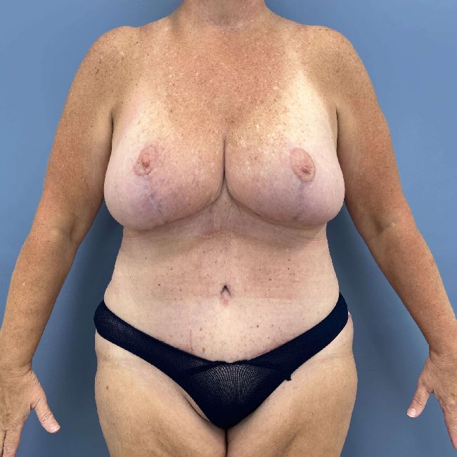 After Image of Overweight Mommy Makeover Front Side View P-6364