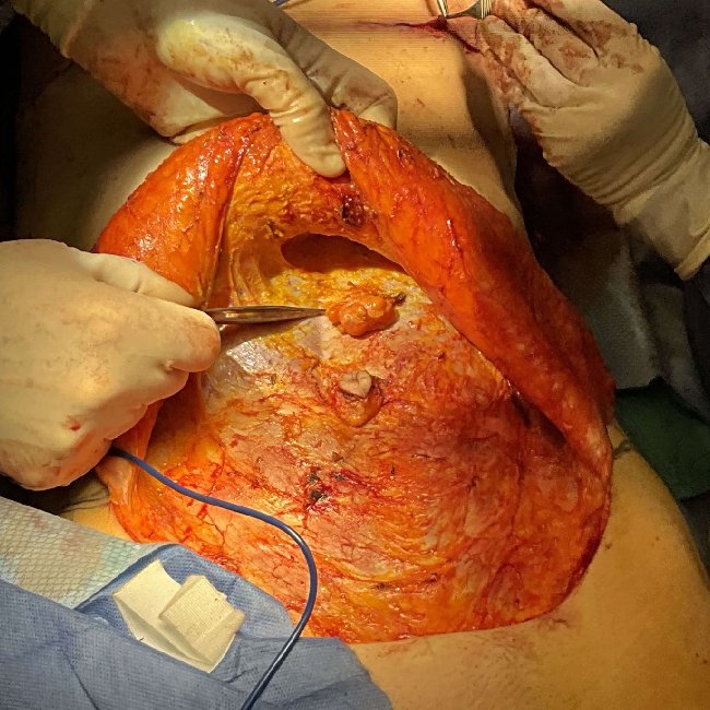 Abdomen Surgery Image of Before Image of Mommy Makeover with Epigastric Hernia Repair p-6373