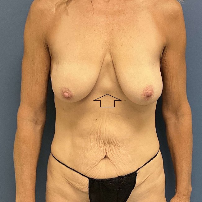 After Image of Mommy Makeover with Epigastric Hernia Repair Front Side View p-6373
