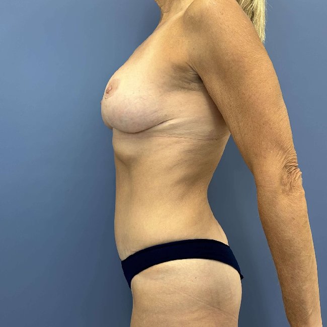 After Image of Mommy Makeover with Epigastric Hernia Repair Left Side View p-6373